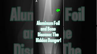 Aluminum Foil and Bone Disease The Hidden Danger [upl. by Elah]