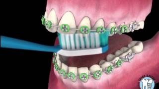 Ortodontik Diş Fırçalama Tekniği ve Diş Teli Varken Dişler Nasıl Fırçalanır [upl. by Inamik]