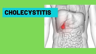 Cholecystitis  Acute cholecystitis  Murphys sign  Signs  symptoms  Treatment [upl. by Livy]