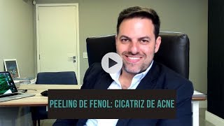 PEELING DE FENOL  CICATRIZ ACNE [upl. by Major31]