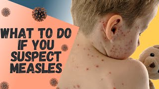 What to do if you think you or your child has MEASLES [upl. by Lancelot]