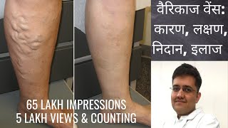 VARICOSE VEINS TREATMENT  VARICOSE VEINS IN HINDI  Dr Gaurav Gangwani [upl. by Karleen]