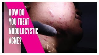 How Do You Treat Nodulocystic Acne  Houston Dermatology [upl. by Atinahc663]