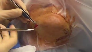 Epidermoid Cyst Removal [upl. by Ttenneb4]