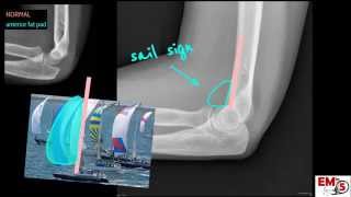 Elbow Xray Interpretation [upl. by Klina417]