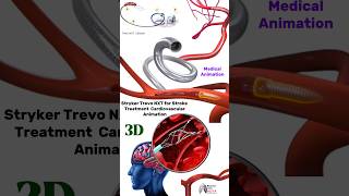 Stryker Trevo NXT Stroke Treatment Animation medical animation 3d short Biology with Aliya [upl. by Adnaloy]