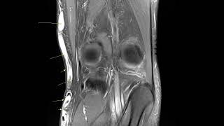 Varicose vein in saphenous vein at knee MRI [upl. by Jesh905]