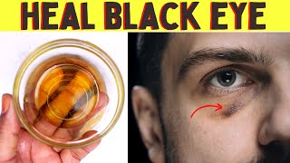 How to heal a black eye faster overnight Fix bruised eye [upl. by Nahs]