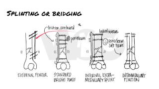 Principles of Fracture Fixation  Orthopedic Basics [upl. by Pail]