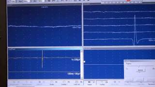 EMG JVC Fasciculaciones [upl. by Tallou209]