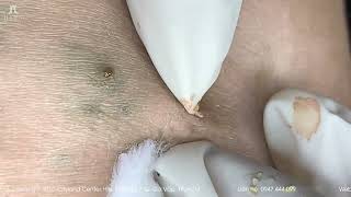 Big Cystic Acne Blackheads Extraction Blackheads amp Milia Whiteheads Removal Pimple Popping shorts [upl. by Leach651]