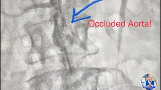 Occluded Aorta infrarenal CTO Revascularization of Aorta and Iliac artery  Lithotripsy amp stent [upl. by Nerrag]