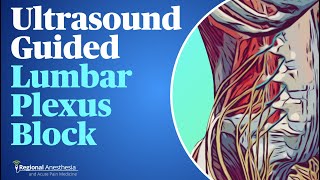 UltrasoundGuided Lumbar Plexus Block [upl. by Llehsad422]