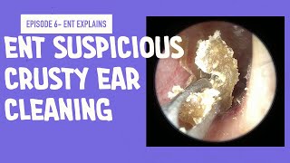 Crusty Ear Cleaning Investigating why young patient has hearing loss Episode 6 [upl. by Blaine]