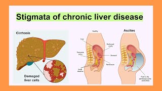 stigmata of chronic liver disease [upl. by Akcirderf872]