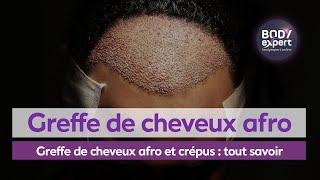 GREFFE DE CHEVEUX TURQUIE  Greffe de cheveux afro et crépus  tout savoir  BODYEXPERT [upl. by Esyned]