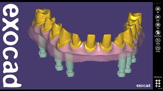 exocad Quick Guide Using the Cutback Library quotThimblequot [upl. by Dionne]