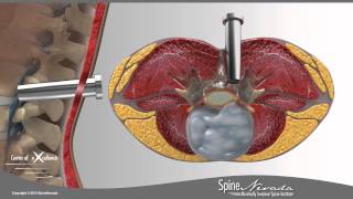 Lumbar Microdiscectomy  Spine Center Northern Nevada Northern California  Spine Surgery [upl. by Gert841]