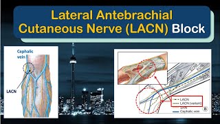 LATERAL ANTEBRACHIAL CUTANEOUS NERVE Block  A quotHowToquot Guide [upl. by Kath]