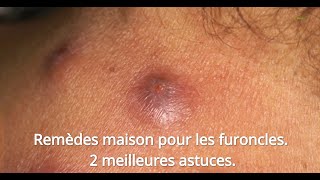 Remèdes Maison Pour Les Furoncles 2 Meilleures Astuces [upl. by Htiel]