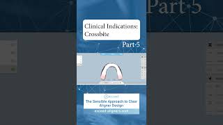 Clinical Indications Crossbite Part 5 [upl. by Eintrok320]