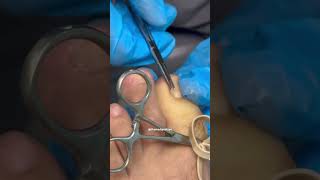 INGROWN REMOVAL 🦶🏼 so satisfying [upl. by Ahsiemat]