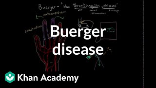 Buerger disease  Circulatory System and Disease  NCLEXRN  Khan Academy [upl. by Boyse241]