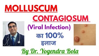 Molluscum Contagiosum ka 100 Treatment [upl. by Durer243]