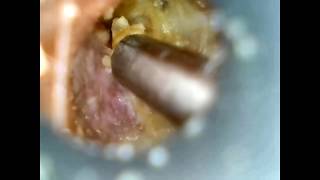 Ear wax removal on exostoses swimmers ear [upl. by Lindy]