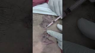 Best Keloid Treatment in Jaipur SkinaaClinic viral shorts [upl. by Ahsietal836]