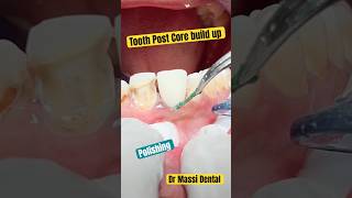 Root Canal Tooth  PostampCore Composite Build up [upl. by Cottle]