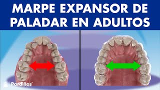 MARPE EXPANSOR de PALADAR  Así funciona el disyuntor de ortodoncia en adultos © [upl. by Sidoon788]