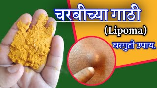 चरबीच्या गाठी मेणासारख्या वितळून जातील या उपायाने dr swagat todkar। lipoma treatment marathi [upl. by Morrison175]