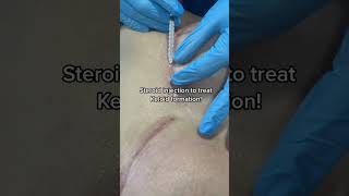 Effective Keloid Treatment for Breast Reduction Scars  Insights from Dr Dahabra Florida shorts [upl. by Anaet]