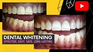 DentalWhitening Effective Easy Safe Longlasting [upl. by Akirre238]