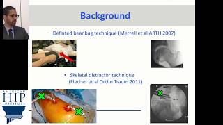 Perineal Pressure During Hip Arthroscopy is Reduced by Introduction of Trendelenburg Positioning [upl. by Ereveneug436]