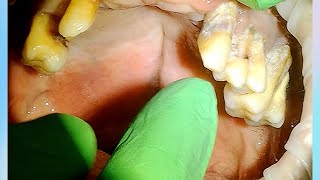 Severe Periodontal Disease Tartar Calculus with Extractions [upl. by Brier]