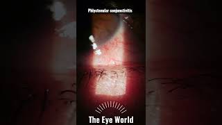 phlyctenular conjunctivitis [upl. by Ikairik]