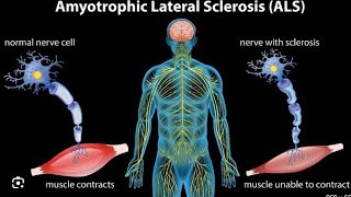 amylotrophic lateral sclerosis skull base fibrous dysplasia [upl. by Alded]