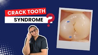 Crack Tooth Syndrome Diagnosis amp Treatment [upl. by Notnilk]