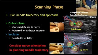 USguided Popliteal Sciatic Nerve Block [upl. by Marga]