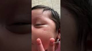 Como quitar los granitos en la cara de los bebes piel atopica o dermatitis en bebes recien nacidos [upl. by Patrizio]