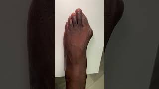 Bunion  Minimally Invasive Surgery Correction MIS [upl. by Ahteres]