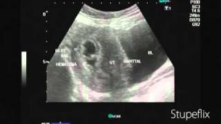 Ultrasound video of subchorionic hematoma early pregnancy [upl. by Roice]