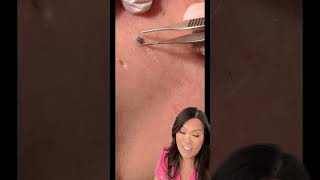 Some great blackheads and DPOWs on the back [upl. by Divadnahtanoj500]