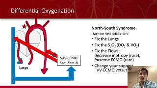 ECMO VA ECMO For Dummies [upl. by Bernardine337]