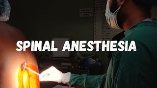 How to give spinal anesthesia  LEARN IN 1 MINUTE [upl. by Denman]