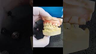 Upper Flexible Partial Denture [upl. by Lleynad]