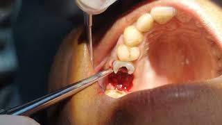 Crown Broke During Extraction How to Extract Rest of The Root Pieces [upl. by Anhoj]