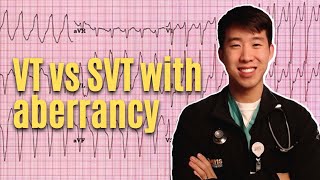 VT vs SVT With Aberrancy Explained  High Yield amp Made Easy [upl. by Greysun]